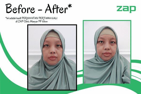 Review ZAP Clinic Manyar, Pengalaman Perawatan Photo Facial Glow 4 Before - After Perawatan di ZAP Clinic