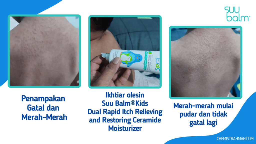 Suu Balm® Kini Hadir di Surabaya, Bye Gatal dalam 5 Menit 6 Suu Balm® Kini Hadir di Surabaya, Bye Gatal dalam 5 Menit 6